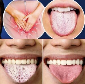 Língua Branca: 6 Possíveis Causas Que Você Não Deve Ignorar