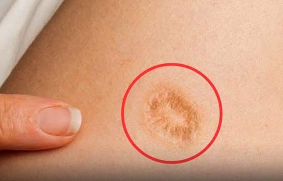A Cicatriz da Vacina BCG: O Que Ela Significa, Mitos, Verdades e Quando Merece Atenção