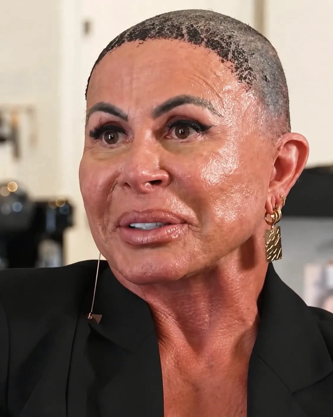 Alopecia androgenética feminina