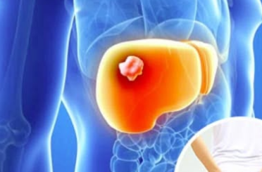 Câncer de fígado: sintomas silenciosos da doença que exige atenção