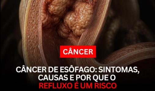 Câncer de esôfago: o sintoma silencioso que muitas pessoas ignoram até ser tarde