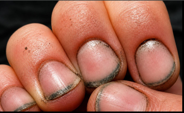 O que pode estar escondido debaixo das unhas preocupa especialistas em saúde